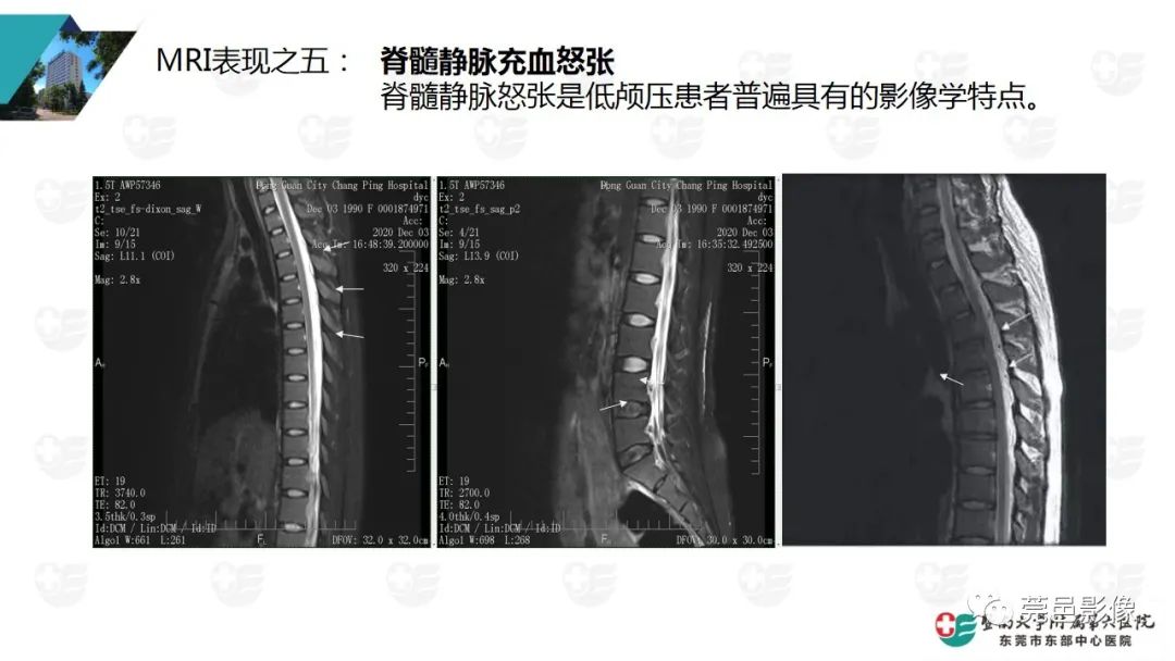 影像PPT - 【PPT】低颅压综合症影像诊断-11