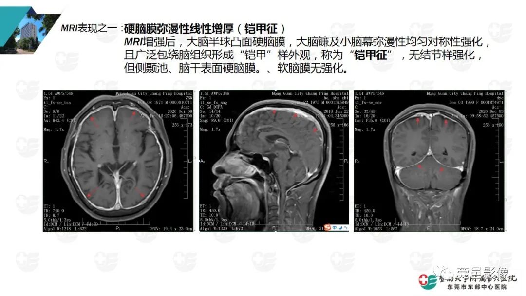影像PPT - 【PPT】低颅压综合症影像诊断-7