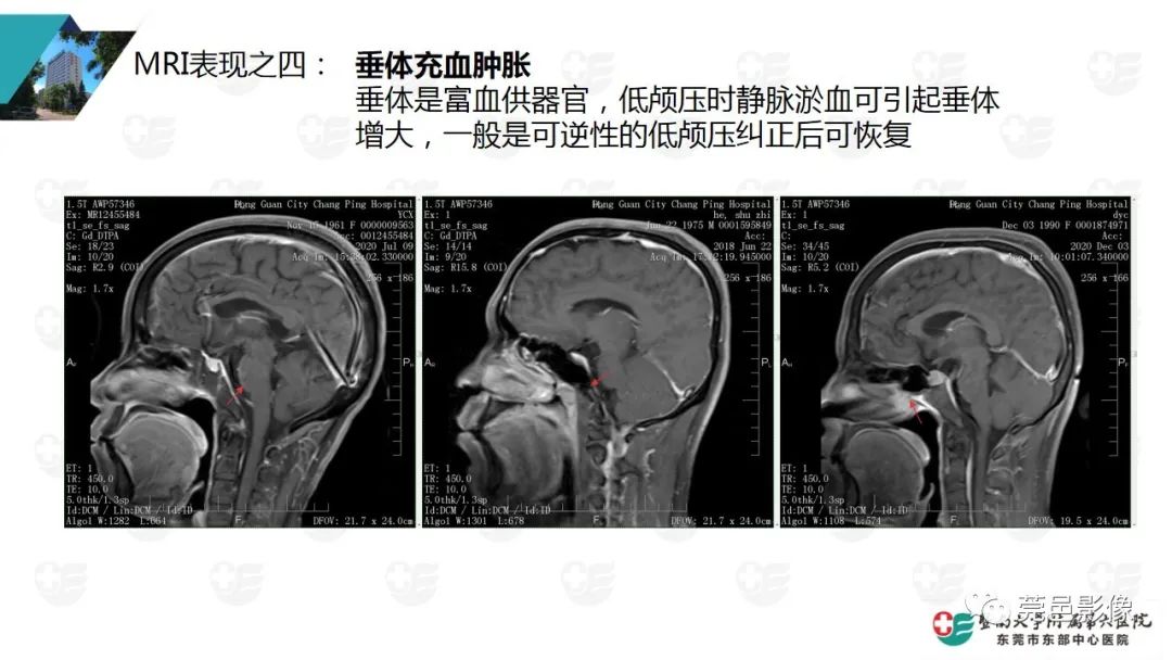 影像PPT - 【PPT】低颅压综合症影像诊断-10