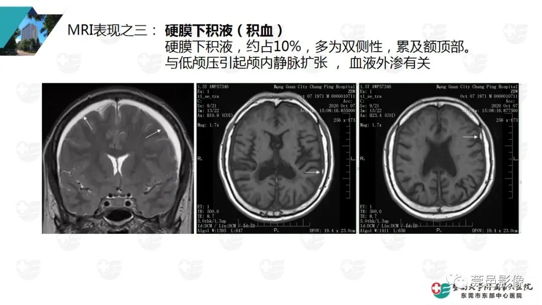 影像PPT - 【PPT】低颅压综合症影像诊断-9
