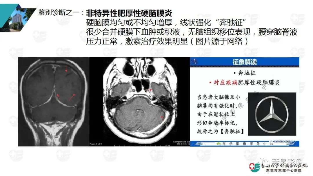影像PPT - 【PPT】低颅压综合症影像诊断-13