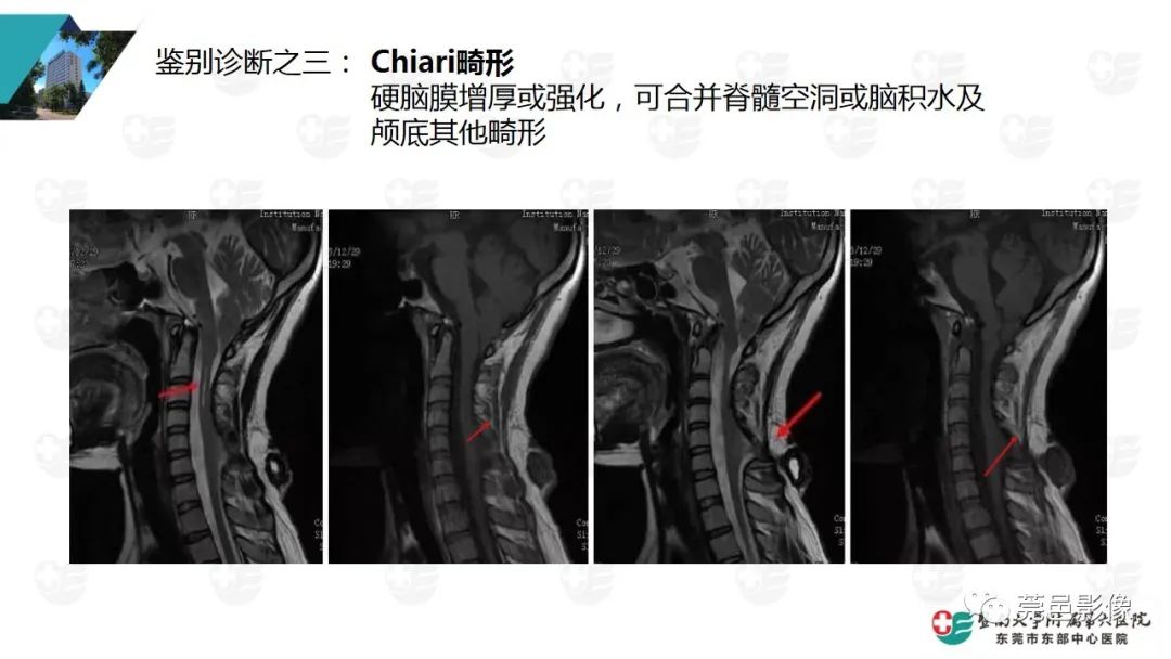 影像PPT - 【PPT】低颅压综合症影像诊断-15