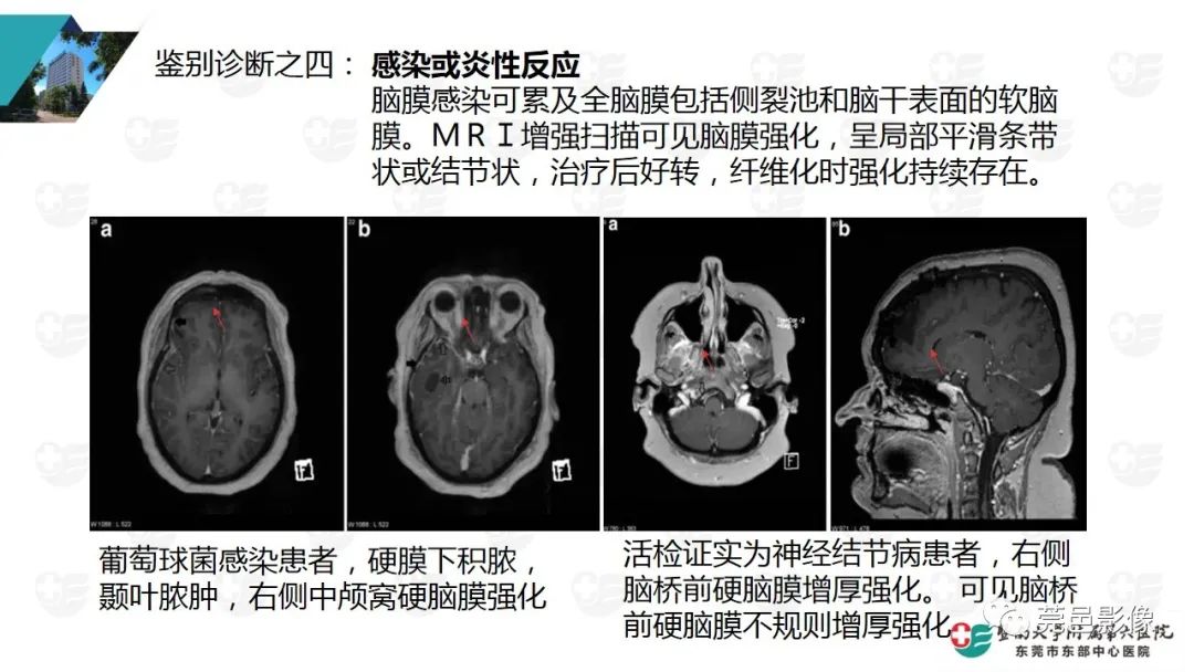 影像PPT - 【PPT】低颅压综合症影像诊断-16