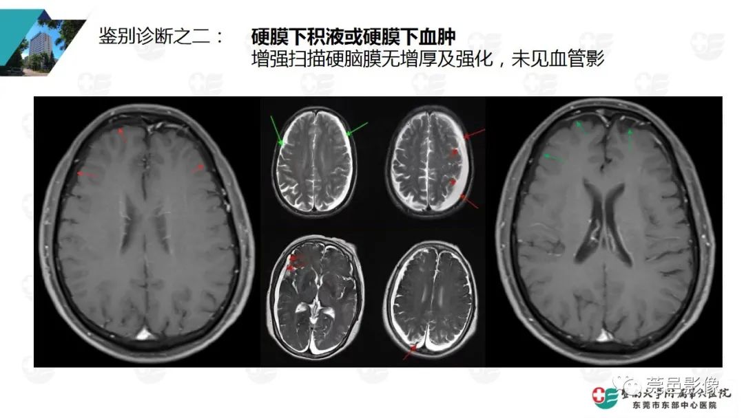 影像PPT - 【PPT】低颅压综合症影像诊断-14