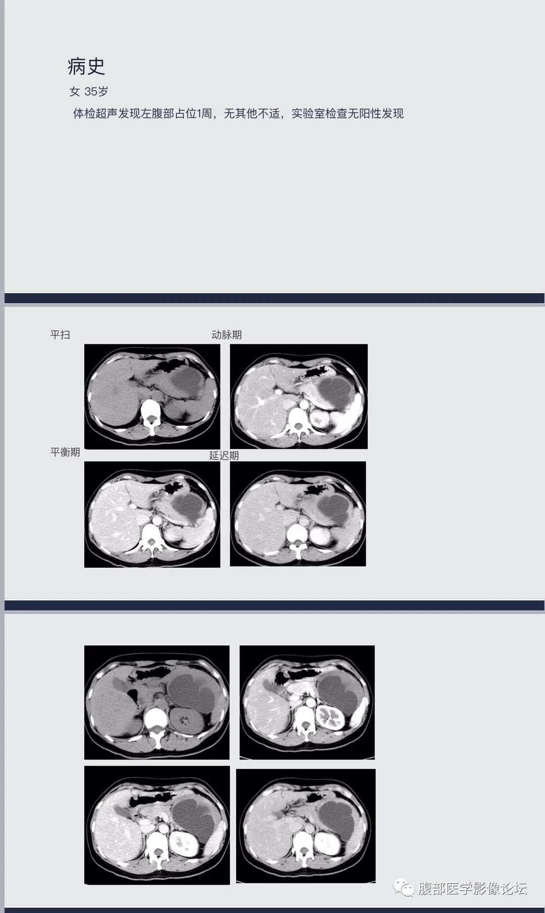 影像PPT - 【病例】腹膜后侵袭性纤维瘤1例CT-2