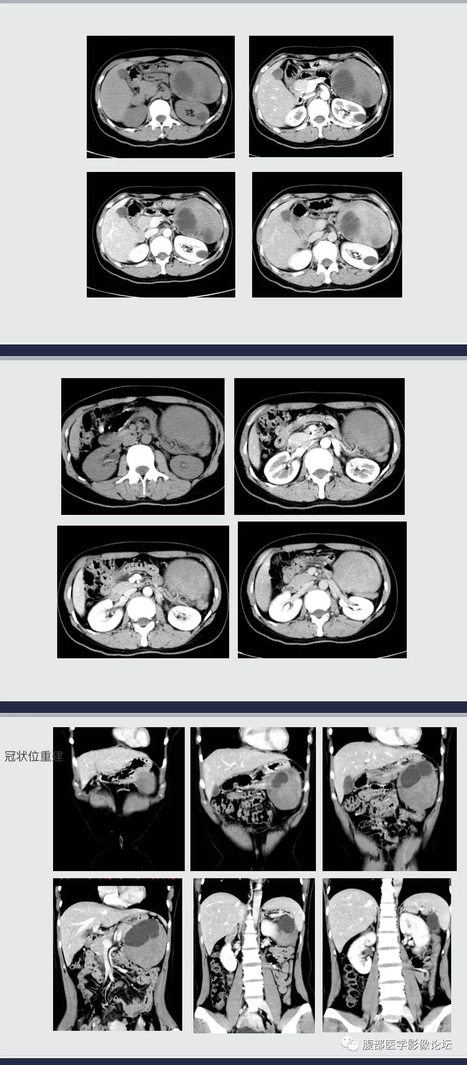 影像PPT - 【病例】腹膜后侵袭性纤维瘤1例CT-3