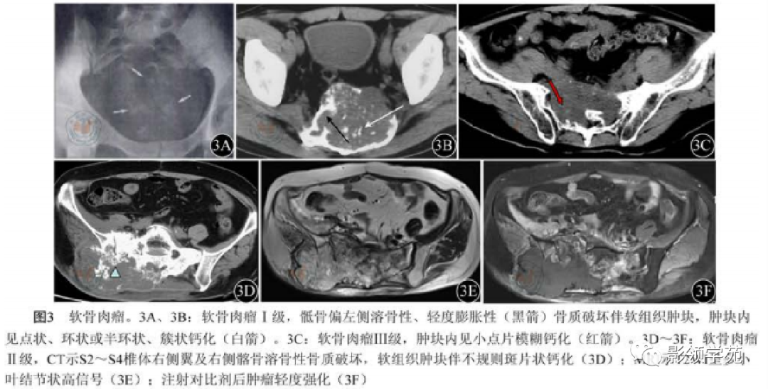 影像PPT - 7种骶骨肿瘤影像表现-10 影像PPT - 7种骶骨肿瘤影像表现-10