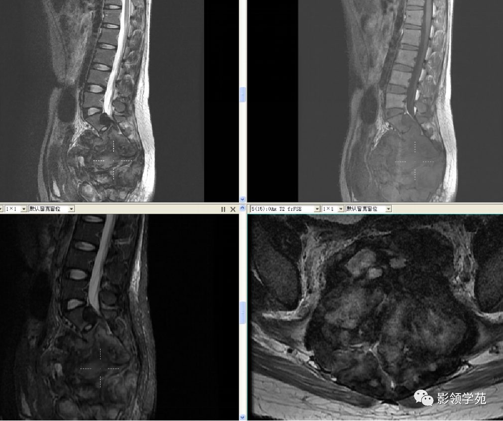 影像PPT - 7种骶骨肿瘤影像表现-12 影像PPT - 7种骶骨肿瘤影像表现-12