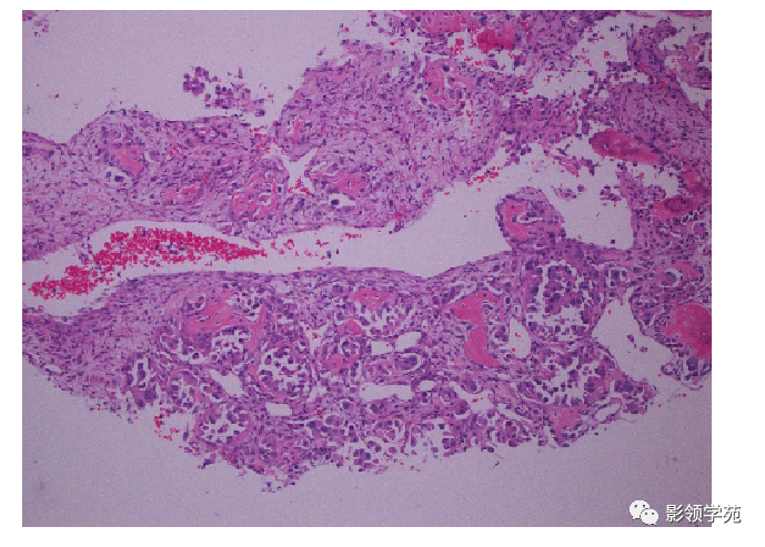 影像PPT - 7种骶骨肿瘤影像表现-19 影像PPT - 7种骶骨肿瘤影像表现-19