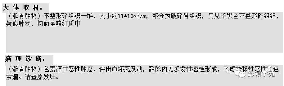 影像PPT - 7种骶骨肿瘤影像表现-24 影像PPT - 7种骶骨肿瘤影像表现-24
