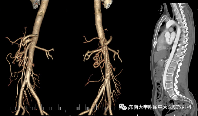 影像PPT - 【PPT】正中弓状韧带压迫综合征（ MALS ）-3