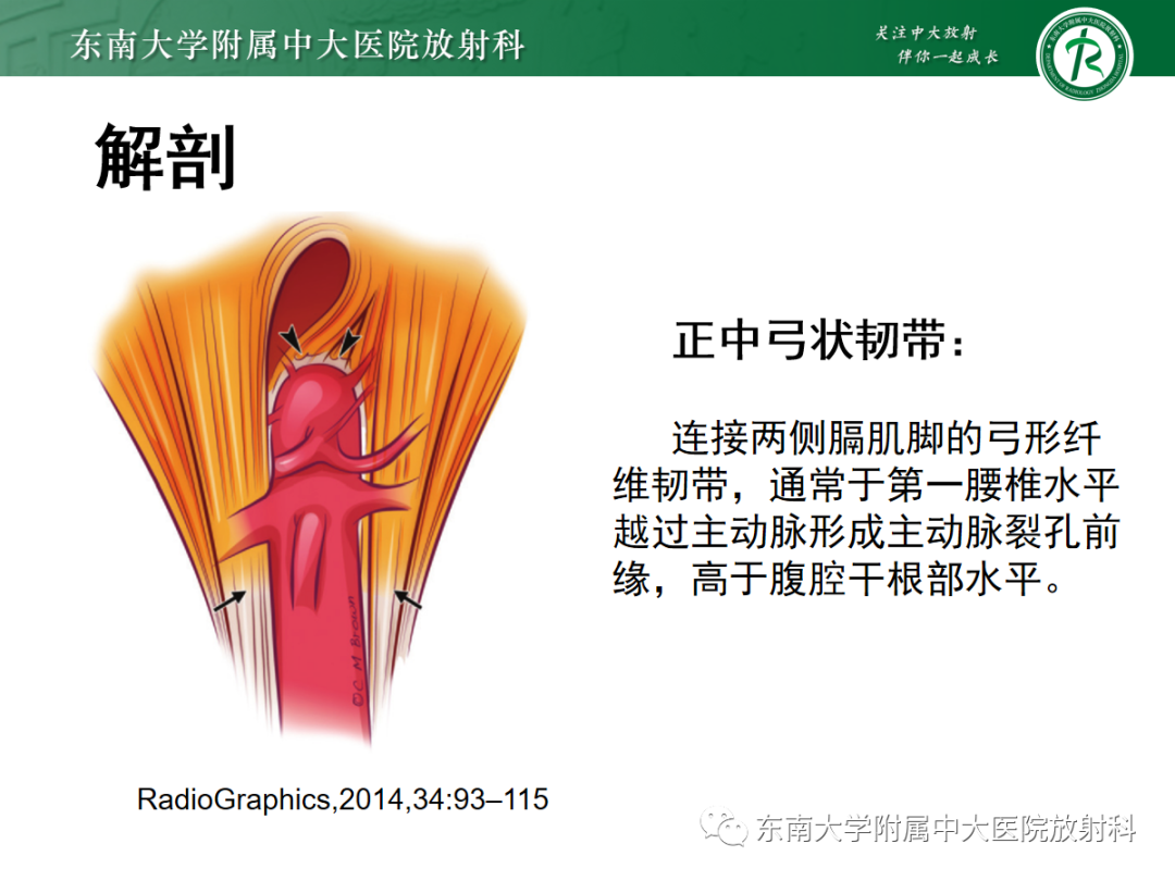 影像PPT - 【PPT】正中弓状韧带压迫综合征（ MALS ）-6