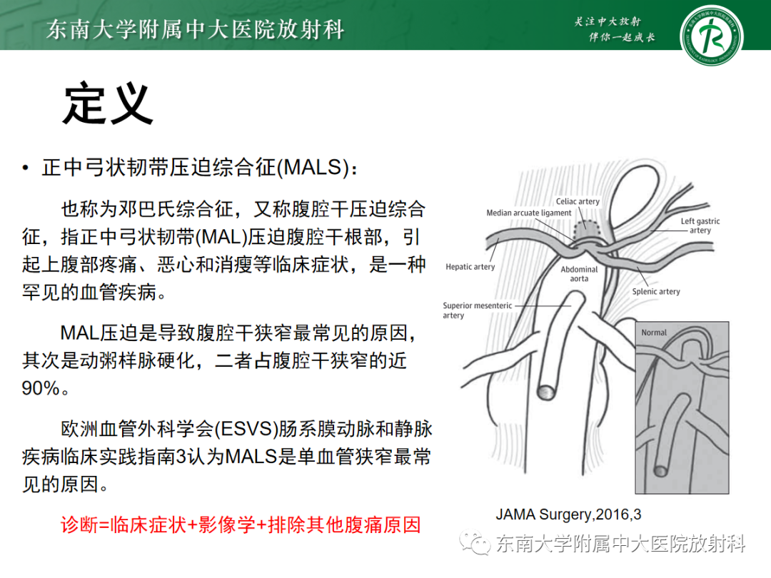影像PPT - 【PPT】正中弓状韧带压迫综合征（ MALS ）-8
