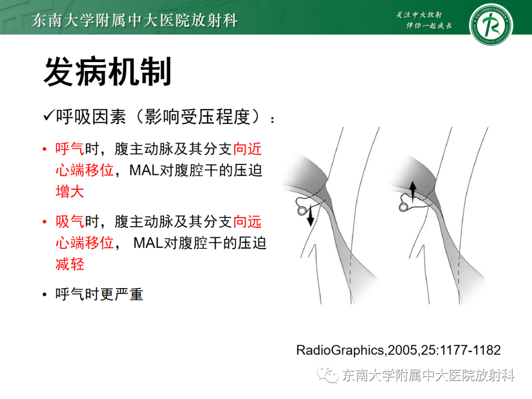 影像PPT - 【PPT】正中弓状韧带压迫综合征（ MALS ）-10