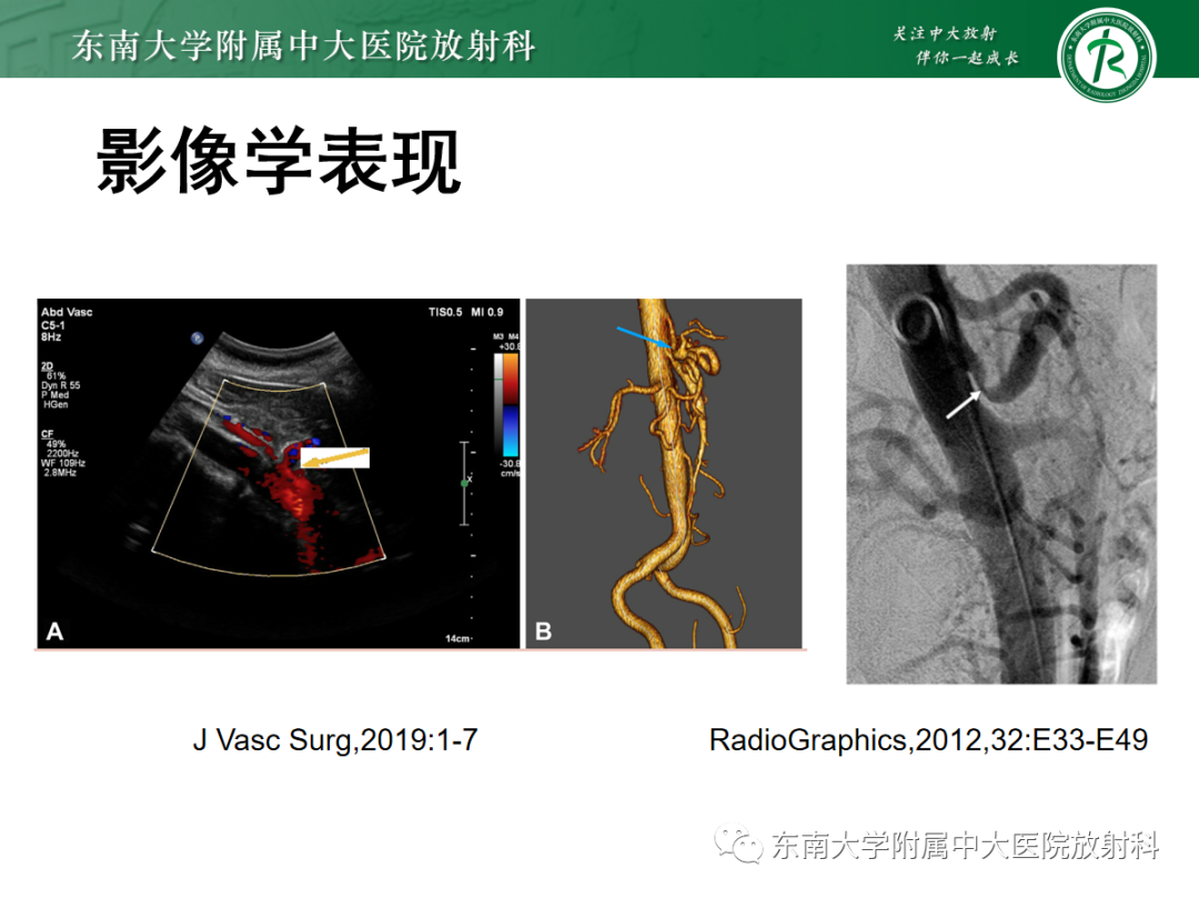影像PPT - 【PPT】正中弓状韧带压迫综合征（ MALS ）-15