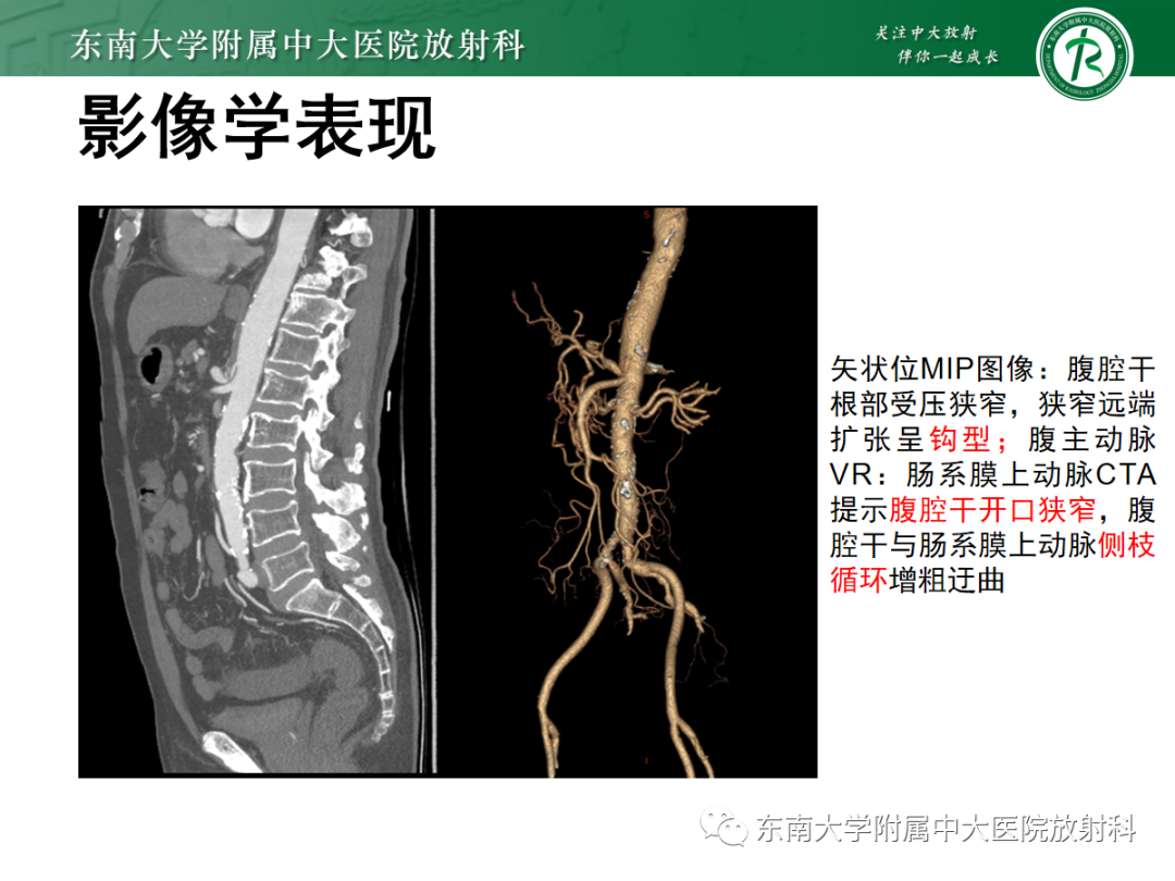 影像PPT - 【PPT】正中弓状韧带压迫综合征（ MALS ）-21