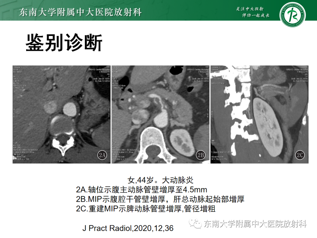 影像PPT - 【PPT】正中弓状韧带压迫综合征（ MALS ）-26