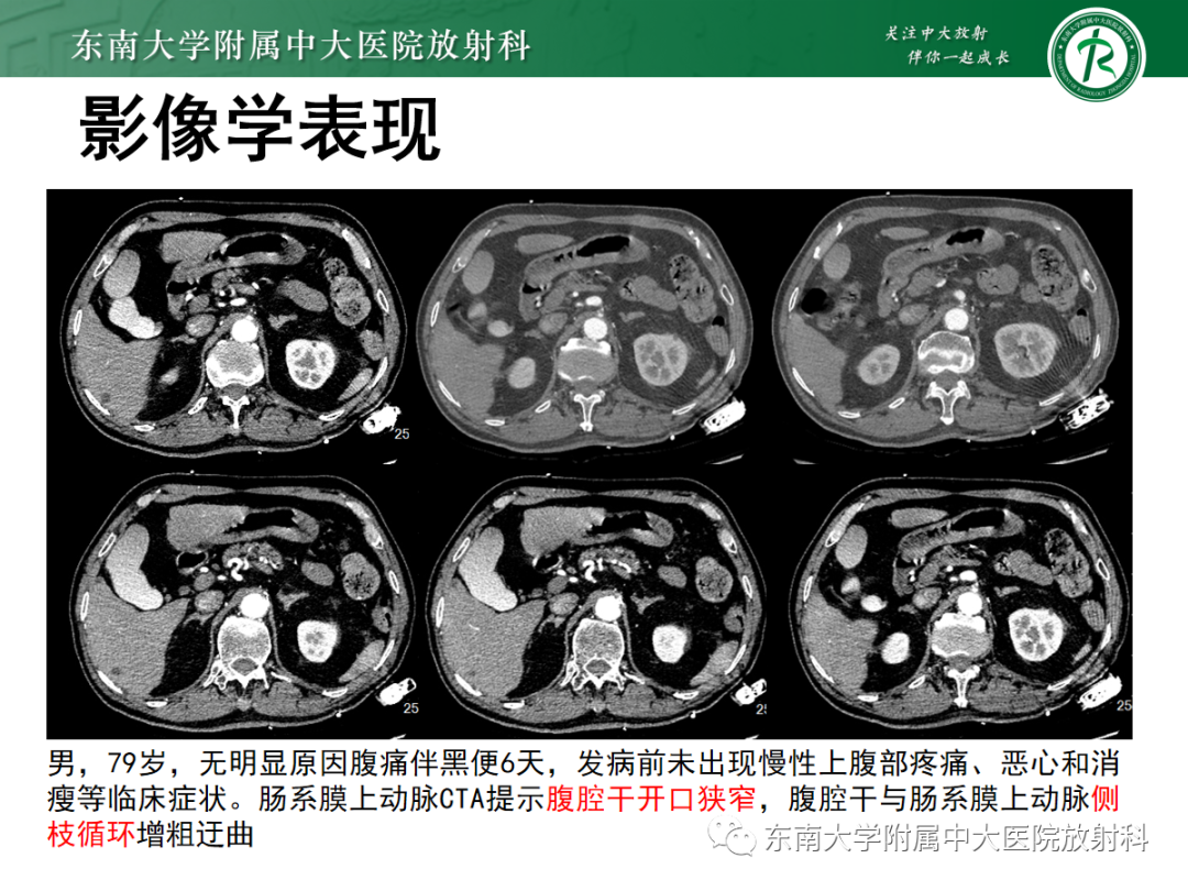影像PPT - 【PPT】正中弓状韧带压迫综合征（ MALS ）-20
