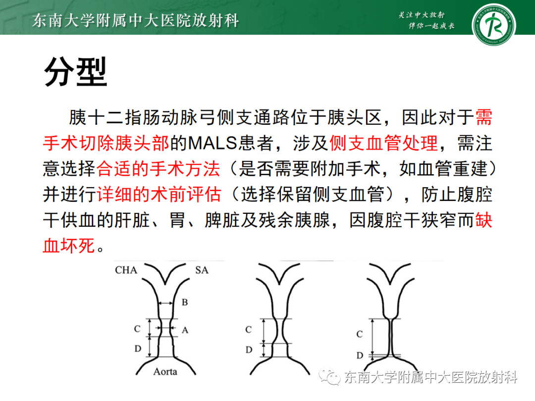 影像PPT - 【PPT】正中弓状韧带压迫综合征（ MALS ）-28