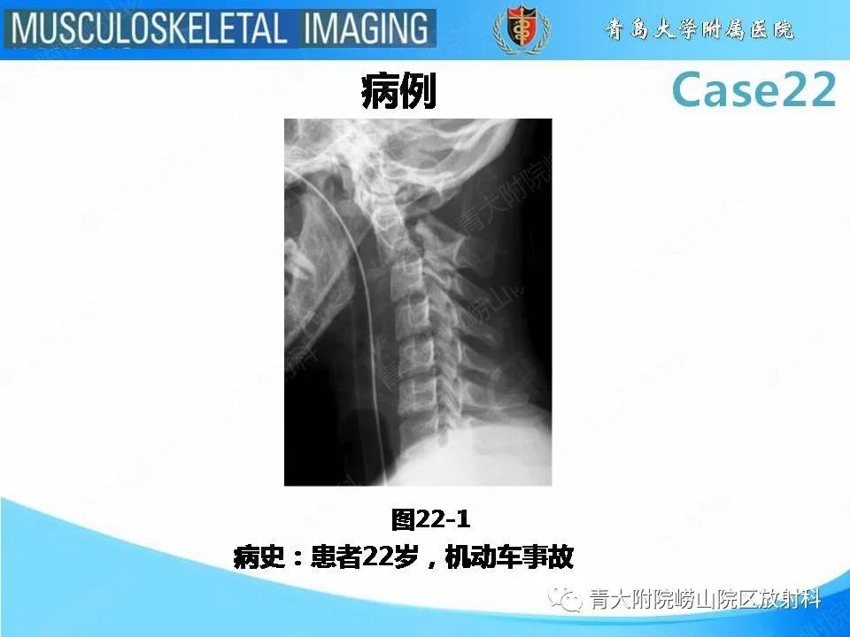 影像PPT - 【PPT】Hangman骨折-2