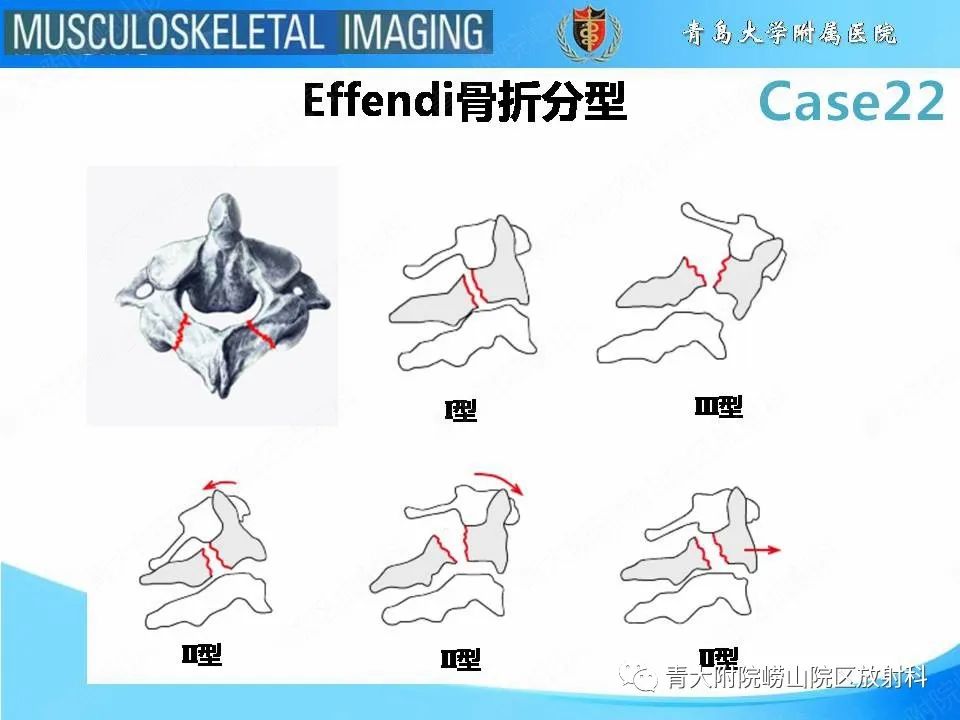 影像PPT - 【PPT】Hangman骨折-12