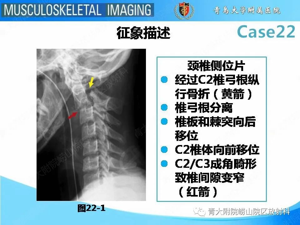 影像PPT - 【PPT】Hangman骨折-16