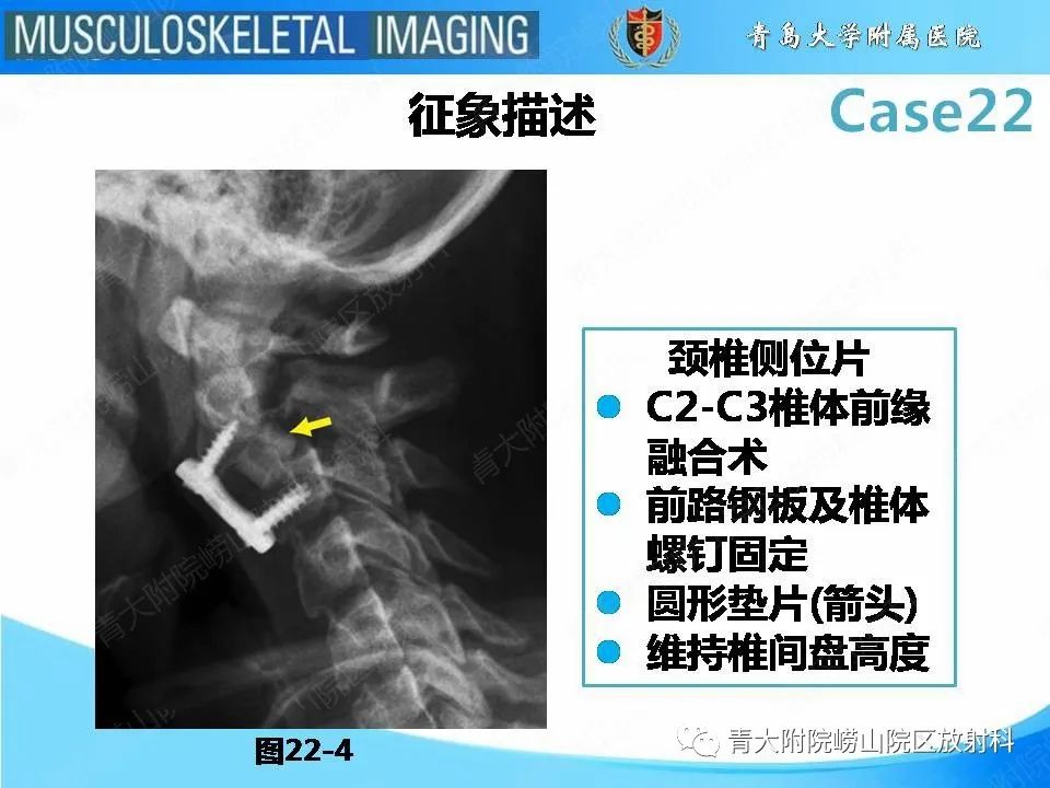 影像PPT - 【PPT】Hangman骨折-19