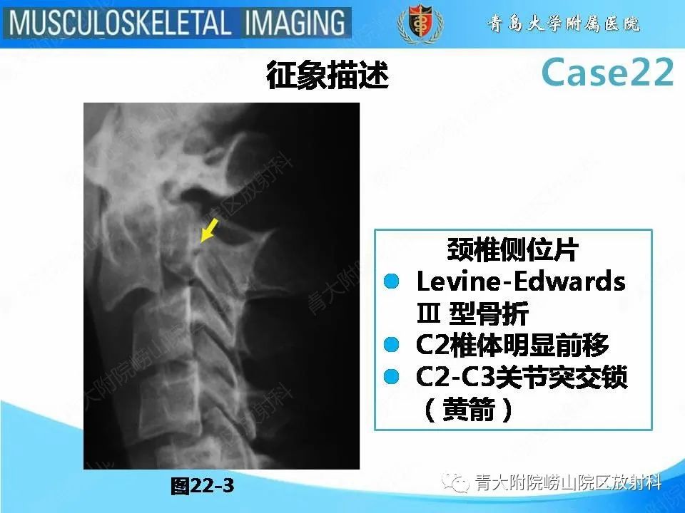 影像PPT - 【PPT】Hangman骨折-18