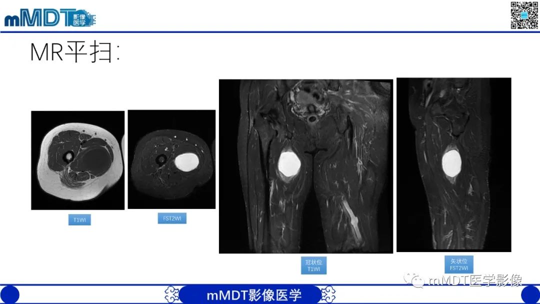影像PPT - 【PPT】肌内粘液瘤的MRI表现-3 影像PPT - 【PPT】肌内粘液瘤的MRI表现-3