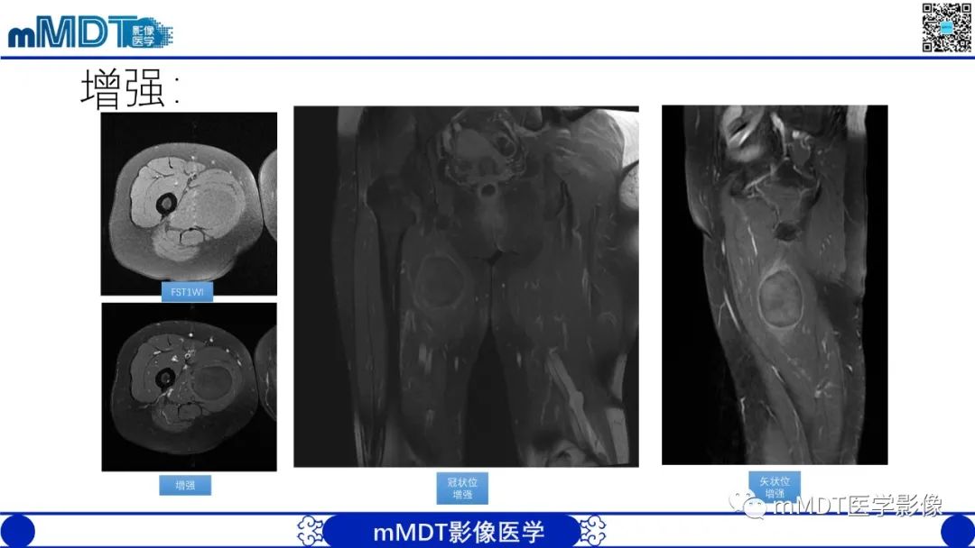 影像PPT - 【PPT】肌内粘液瘤的MRI表现-6 影像PPT - 【PPT】肌内粘液瘤的MRI表现-6