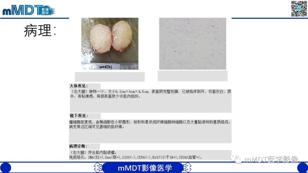 影像PPT - 【PPT】肌内粘液瘤的MRI表现-8 影像PPT - 【PPT】肌内粘液瘤的MRI表现-8
