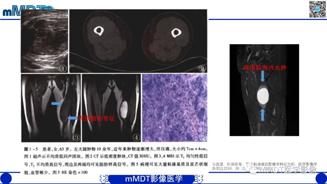 影像PPT - 【PPT】肌内粘液瘤的MRI表现-12 影像PPT - 【PPT】肌内粘液瘤的MRI表现-12