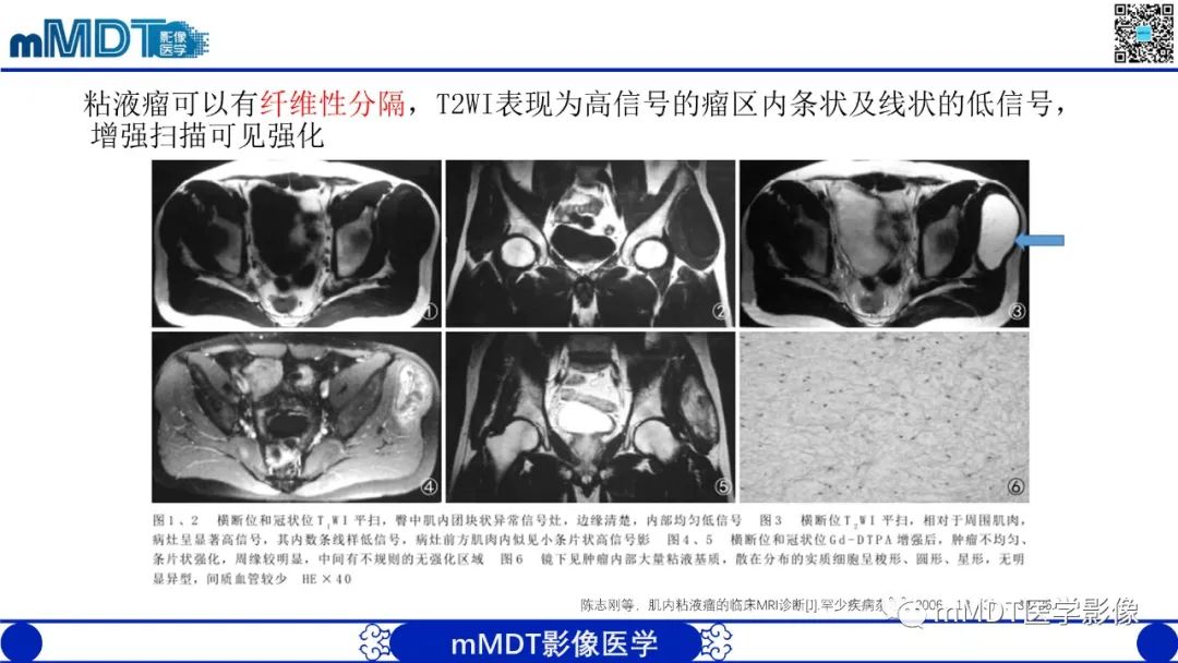 影像PPT - 【PPT】肌内粘液瘤的MRI表现-13 影像PPT - 【PPT】肌内粘液瘤的MRI表现-13