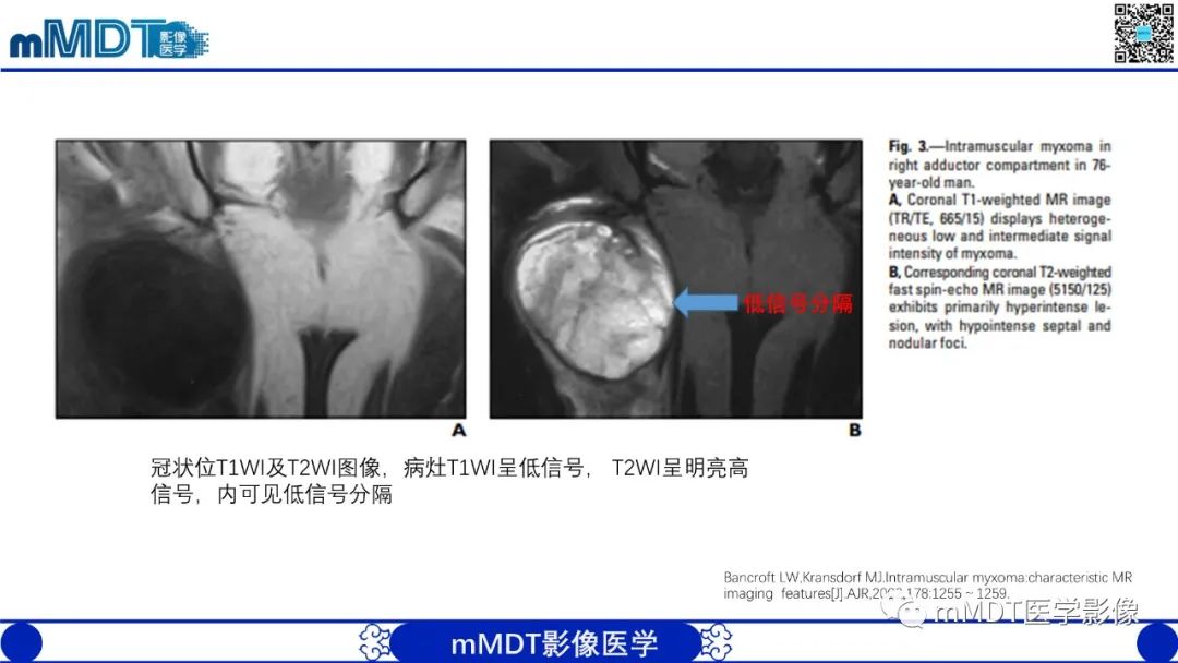影像PPT - 【PPT】肌内粘液瘤的MRI表现-14 影像PPT - 【PPT】肌内粘液瘤的MRI表现-14