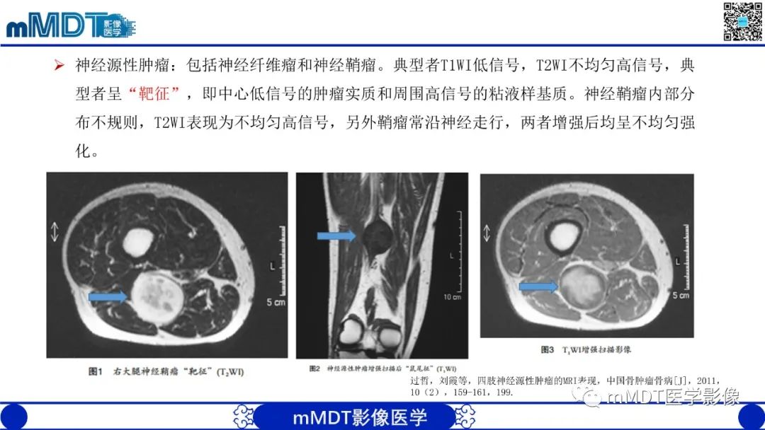 影像PPT - 【PPT】肌内粘液瘤的MRI表现-16 影像PPT - 【PPT】肌内粘液瘤的MRI表现-16