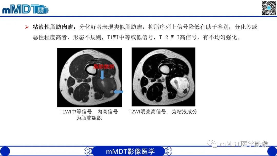 影像PPT - 【PPT】肌内粘液瘤的MRI表现-18 影像PPT - 【PPT】肌内粘液瘤的MRI表现-18