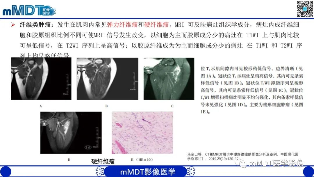 影像PPT - 【PPT】肌内粘液瘤的MRI表现-17 影像PPT - 【PPT】肌内粘液瘤的MRI表现-17