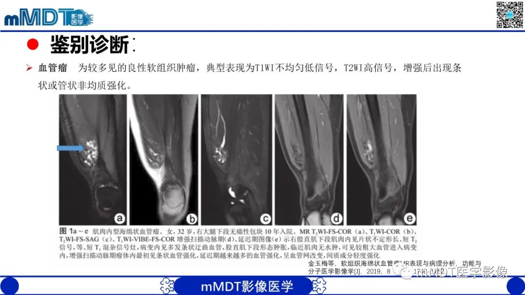 影像PPT - 【PPT】肌内粘液瘤的MRI表现-15 影像PPT - 【PPT】肌内粘液瘤的MRI表现-15