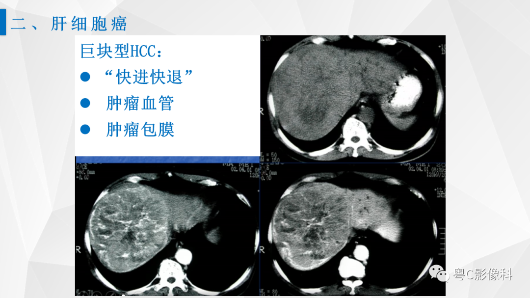 影像PPT - 【PPT】肝脏CT/MRI增强扫描“快进快退”的诊断思路-6