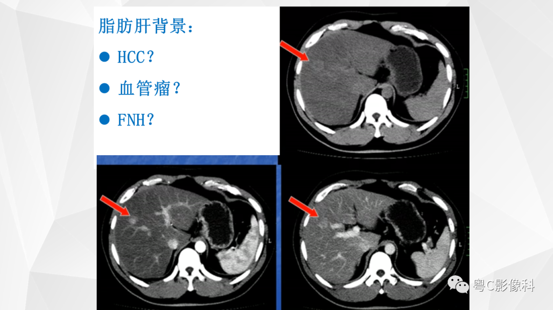 影像PPT - 【PPT】肝脏CT/MRI增强扫描“快进快退”的诊断思路-9