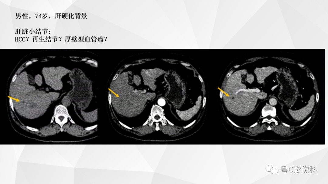 影像PPT - 【PPT】肝脏CT/MRI增强扫描“快进快退”的诊断思路-12