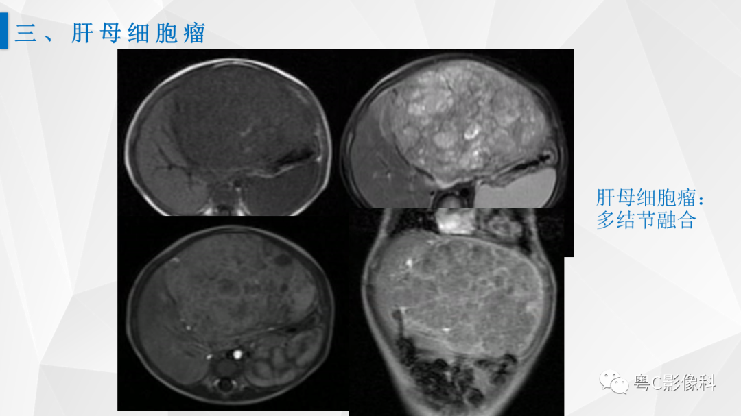 影像PPT - 【PPT】肝脏CT/MRI增强扫描“快进快退”的诊断思路-19