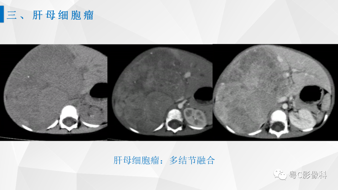 影像PPT - 【PPT】肝脏CT/MRI增强扫描“快进快退”的诊断思路-18