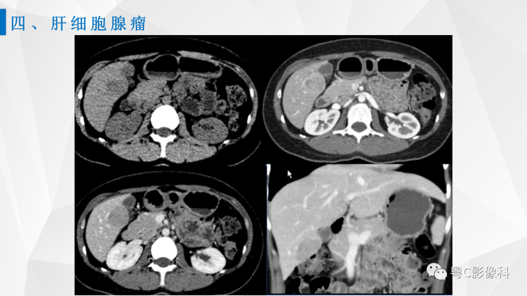 影像PPT - 【PPT】肝脏CT/MRI增强扫描“快进快退”的诊断思路-23