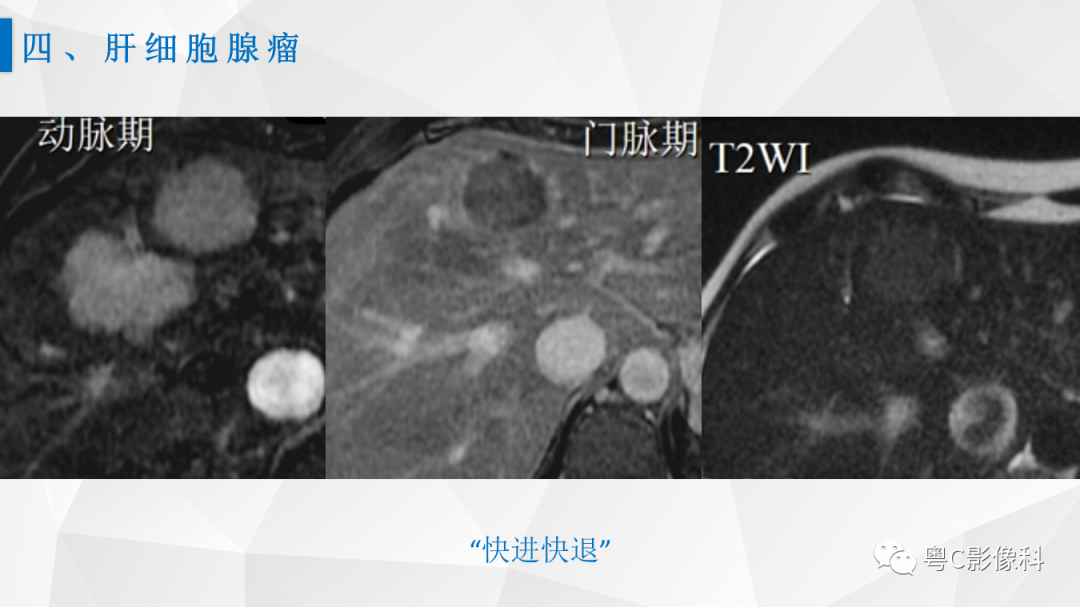 影像PPT - 【PPT】肝脏CT/MRI增强扫描“快进快退”的诊断思路-25
