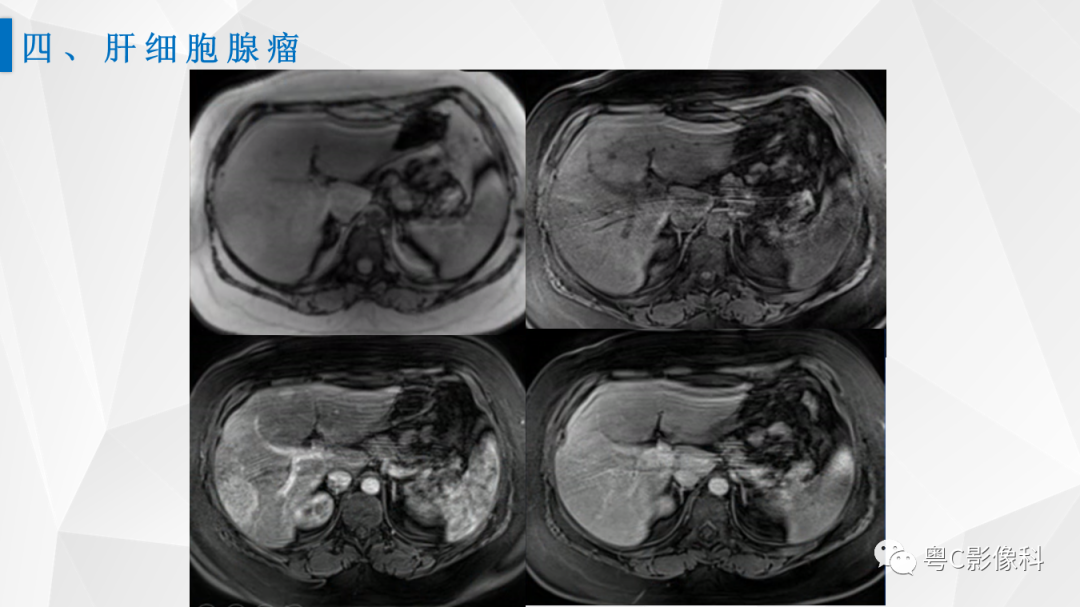 影像PPT - 【PPT】肝脏CT/MRI增强扫描“快进快退”的诊断思路-27