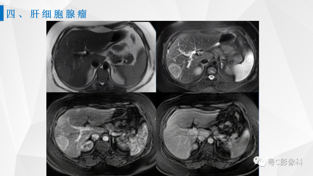 影像PPT - 【PPT】肝脏CT/MRI增强扫描“快进快退”的诊断思路-28