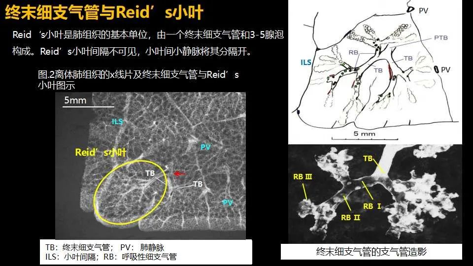 影像PPT - 【PPT】超高分辨率CT(U-HRCT)对弥漫性肺部疾病的放射-病理相关性探究：从Miller\'s到Reid\'s小叶-4