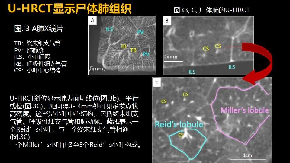 影像PPT - 【PPT】超高分辨率CT(U-HRCT)对弥漫性肺部疾病的放射-病理相关性探究：从Miller\'s到Reid\'s小叶-5