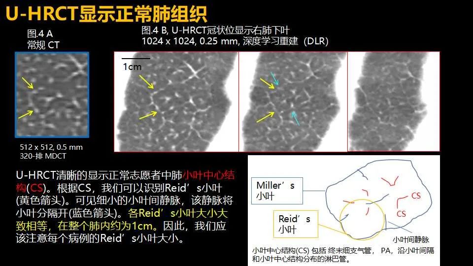 影像PPT - 【PPT】超高分辨率CT(U-HRCT)对弥漫性肺部疾病的放射-病理相关性探究：从Miller\'s到Reid\'s小叶-6